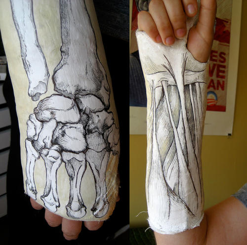 Anatomical drawing on a cast / Boing Boing