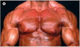 steroids side effects acne